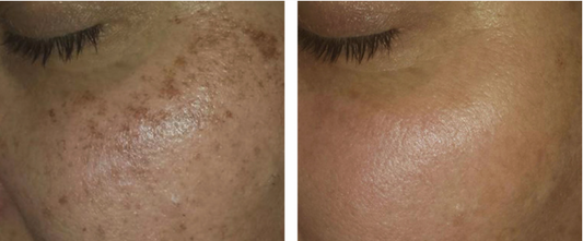 Pigmentation facials and whats best for you. Oak Flats, Oak & Eve Beauty