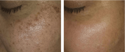 Wanting to treat your pigmentation? - Oak & Eve Beauty 